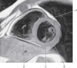 In The Figure Below Of A Short Axis T1 Weighted MRI Of The Heart