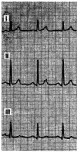Examine the six extremity leads shown in the figure below. What is the appropriate mean QRS axis?     (From Goldberger AL: Clinical Electrocardiography: A Simplified Approach, 6th ed. St Louis, Mosby, 1999, p 55.)  A)  −30° B)  60° C)  90° D)  120°