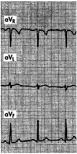 Examine the six extremity leads shown in the figure below. What is the appropriate mean QRS axis?     (From Goldberger AL: Clinical Electrocardiography: A Simplified Approach, 6th ed. St Louis, Mosby, 1999, p 55.)  A)  −30° B)  60° C)  90° D)  120°