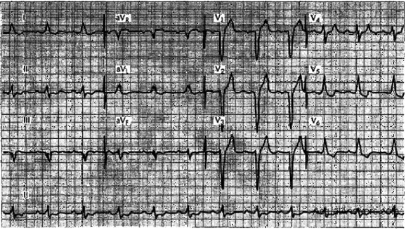 In the ECG shown on the following page, which of the following conduction abnormalities is indicated?   A)  RBBB. B)  Third-degree AV block. C)  First-degree AV block. D)  Mobitz I.
