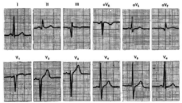 In the ECG strip shown below, what disorder is indicated?   (From Goldberger AL: Clinical Electrocardiography: A Simplified Approach, 6th ed. St. Louis, Mosby, 1999, p 91.)  A)  Acute pericarditis. B)  Inferior MI. C)  Posterior MI. D)  Anterior MI.
