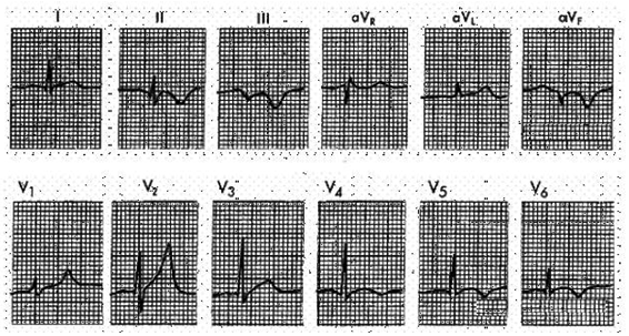 In the ECG strip shown below, what disorder is indicated?   (From Goldberger AL: Clinical Electrocardiography: A Simplified Approach, 6th ed. St. Louis, Mosby, 1999, p 91.)  A)  Subendocardial ischemia. B)  Transmural ischemia. C)  Acute inferior MI. D)  Posterior MI.