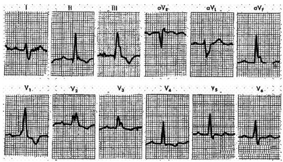 In the ECG strip shown below, what abnormality is indicated?   (From Goldberger AL: Clinical Electrocardiography: A Simplified Approach, 6th ed. St. Louis, Mosby, 1999, p 70.)  A)  LBBB. B)  Posterior wall MI. C)  RBBB. D)  LVH.