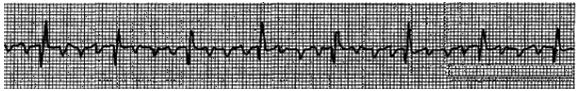 In the ECG strip shown below, which arrhythmia is indicated?   A)  Atrial flutter. B)  Atrial fibrillation. C)  Premature atrial contractions. D)  Atrial tachycardia.