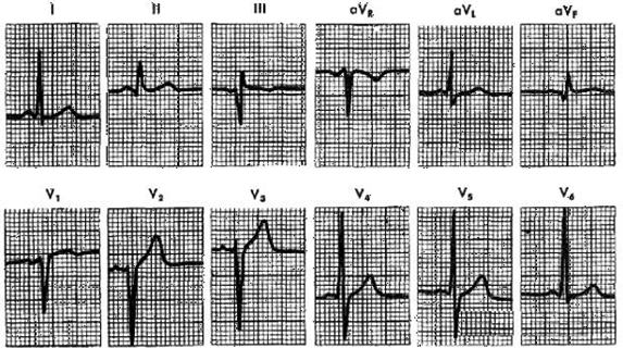 In the ECG strip shown below, what disorder is indicated?   A)  Acutepericarditis. B)  Inferior MI. C)  Posterior MI. D)  Anterior MI. (From Goldberger AL: Clinical Electrocardiography: A Simplified Approach, 6th ed. St. Louis, Mosby, 1999, p 91.) 