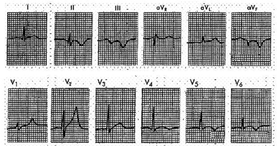 In the ECG strip shown below, what disorder is indicated?   A)  Subendocardial ischemia. B)  Transmural ischemia. C)  Acute inferior MI. D)  Posterior MI (From Goldberger AL: Clinical Electrocardiography: A Simplified Approach, 6th ed. St. Louis, Mosby, 1999,p91.) 