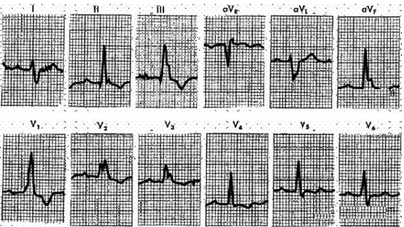 In the ECG strip shown below, what abnormality is indicated?   A)  LBBB. B)  Posterior wall MI. C)  RBBB. D)  LVH. (From Goldberger AL: Clinical Electrocardiography: A Simplified Approach, 6th ed. St. Louis, Mosby, 1999, p 70.) 