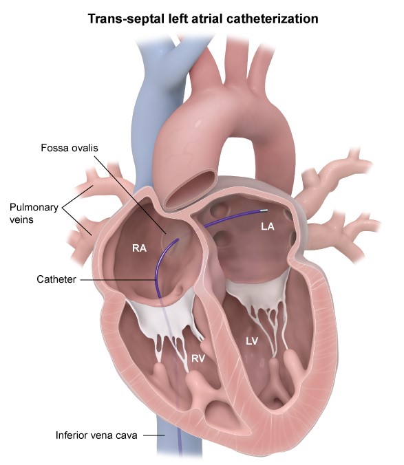 B   A <strong>venous catheter</strong> traveling from the femoral vein to the heart passes through the iliac vein and inferior vena cava to reach the <strong>right atrium</strong>.  Once in the right atrium, structures within the right side of the heart and the pulmonary arteries are readily accessible.  However, because the pulmonary capillaries are far too small to pass through, the left side of the heart must be accessed by <strong>traversing the interatrial septum</strong>.  The interatrial septum is traversed at the site of the <strong>foramen ovale</strong>, which in adults is typically covered by a thin membrane of fibrous tissue that can be easily punctured. Entry into the <strong>left atrium</strong> allows for direct measurement of left atrial pressure (rather than an estimate via pulmonary capillary wedge pressure) and for access to arrhythmogenic foci that may be located on the left atrial myocardium or the pulmonary veins.  Following the procedure, the small atrial septal defect created by the catheter typically closes spontaneously. <strong>(Choice A)</strong>  Arterial catheterization of the left side of the heart typically starts in the femoral or radial artery and proceeds to the ascending aorta where pressure can be measured or dye can be placed into the coronary arteries to visualize atherosclerotic obstruction (ie, coronary angiography).  In addition, the aortic valve may be crossed to measure left ventricular pressure.  However, retrograde crossing of the structurally complex mitral valve is highly difficult, and the left atrium is not accessed via this route. <strong>(Choice C)</strong>  The interventricular septum is not traversed during heart catheterization because the myocardium is thick and difficult to puncture, and high left ventricular pressure would likely prevent spontaneous closure of the ventricular septal defect that is created. <strong>(Choices D and E)</strong>  The tricuspid valve is crossed during venous catherization to access the right ventricle, and the pulmonic valve is subsequently crossed to access the pulmonary arteries.  However, because the catheter cannot pass through the pulmonary capillaries, the left atrium cannot be accessed via this route. <strong>Educational objective:</strong> To access the left side of the heart, cardiac venous catheters must cross the interatrial septum at the site of the foramen ovale.  Entry into the left atrium allows for direct measurement of left atrial pressure and for access to arrhythmogenic foci on the left atrial myocardium or pulmonary veins. __________ References: Emerging applications for transseptal left heart catheterization old techniques for new procedures. (http://www.ncbi.nlm.nih.gov/pubmed/18510957)