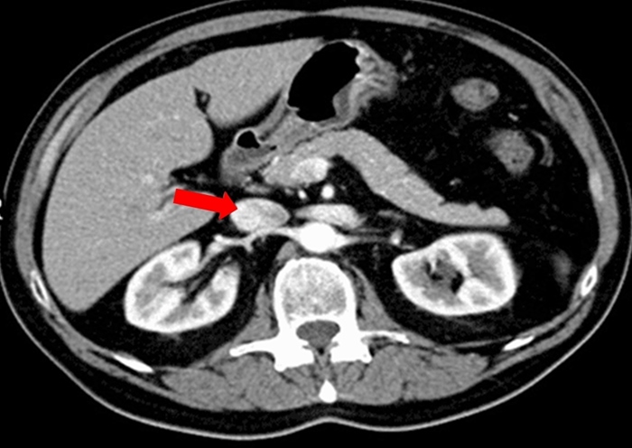 A 52-year-old man is being evaluated for nonspecific, chronic abdominal pain.  As part of the workup, he undergoes an abdominal CT scan with intravenous contrast, which reveals no significant findings.  An axial image from the scan is shown below.   Which of the following statements best describes the structure indicated by the arrow? A) It drains into the left subclavian vein in the thorax. B) It drains through the cystic duct into the common bile duct. C) It gives rise to the right and left renal arteries. D) It is formed by the union of the common iliac veins. E) It joins the splenic vein to form the portal vein.