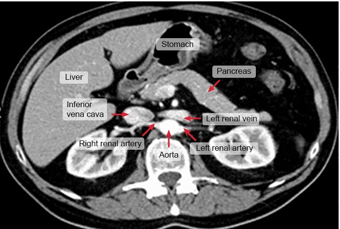 D   This axial CT image reveals the abdomen near the L1 vertebral level.  At this level, the <strong>inferior vena cava (IVC)</strong> lies just anterior to the right renal artery and to the right of the aorta.  The IVC is formed by the <strong>union of the right and left common iliac veins</strong> at the level of L4-L5 and drains into the right atrium just above the level of the diaphragm at T8.  The IVC returns venous blood to the right atrium from the lower extremities, portal system, and abdominal and pelvic viscera. <strong>(Choice A)</strong>  The thoracic duct drains lymph from the entire left side of the body and all regions inferior to the umbilicus (including the entire gastrointestinal tract).  It enters the thorax through the aortic hiatus and empties into the left subclavian vein near its junction with the internal jugular vein. <strong>(Choice B)</strong>  The cystic duct drains bile from the gallbladder into the common bile duct.  The gallbladder is typically visualized just below the liver in the anterior right abdomen but is not well seen in this image. <strong>(Choice C)</strong>  The image reveals the abdominal aorta giving rise to the right and left renal arteries at the L1 vertebral level.  The abdominal aorta lies posteromedial to the IVC within the abdomen. <strong>(Choice E)</strong>  The superior mesenteric vein joins the splenic vein to form the portal vein.  The portal vein can be seen vaguely near the head of the pancreas in this cross-sectional image. <strong>Educational objective:</strong> The inferior vena cava is formed by the union of the right and left common iliac veins at the level of L4-L5.  The renal arteries and veins lie at the level of L1.  The inferior vena cava returns venous blood to the heart from the lower extremities, portal system, and abdominal and pelvic viscera.