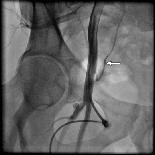 <strong>During cardiac catheterization, an artery indicated by the arrow in the picture was visualized after injecting the contrast material, What is the origin of this artery?  </strong> A) Internal Iliac Artery B) External Iliac Artery C) Common Femoral Artery D) Superior Gluteal Artery <div style=padding-top: 35px> 