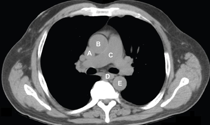 A 55-year-old man is brought to the emergency department due to shortness of breath, productive cough, and confusion.  His wife mentions that last week he was diagnosed with the flu and his symptoms have progressively worsened.  Temperature is 39.4 C (103 F) , blood pressure is 80/50 mm Hg, pulse is 120/min, and respiratory rate is 22/min.  Pulse oximetry shows 86% on room air.  On physical examination, the patient is obtunded and in respiratory distress.  He is intubated, given a 2-L bolus of normal saline, and started on broad spectrum antibiotics after blood cultures are obtained.  A central line is placed to access a structure embryonically derived from the common cardinal veins.  This structure is represented by which of the following labels shown in the chest CT scan below?   A) A B) B C) C D) D E) E