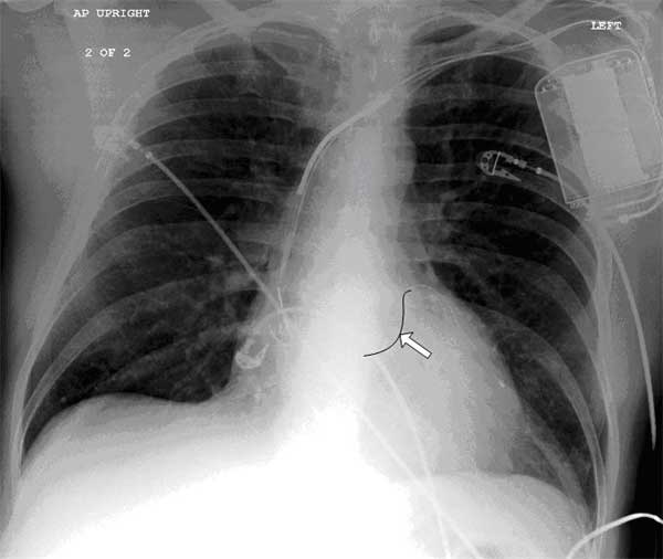 A 65-year-old man with a history of coronary artery disease visits his doctor with complaints of exertional shortness of breath, weariness, and lower limb edema. His medical history is notable for a myocardial infarction 5 years ago and the placement of an electronic pacemaker 2 years ago. The x-ray of his chest is seen below. One of the leaders' segments is highlighted (arrow) .   The highlighted segment most likely lies within which of the following structures? A) Anterior interventricular sulcus B) Atrioventricular groove C) Pulmonary artery D) Right atrium E) Right ventricle