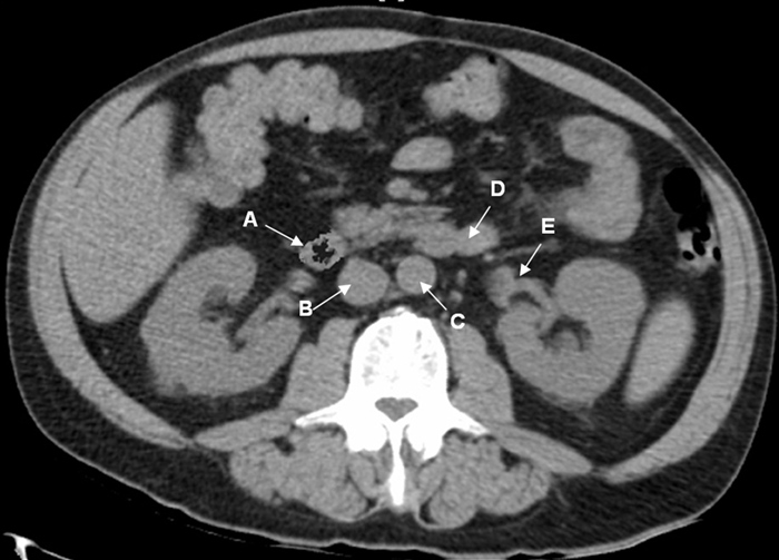 A 63-year-old man comes to the emergency department due to pain and swelling of the right calf.  He has a history of recurrent gastrointestinal hemorrhage and was discharged from the hospital 4 days ago following a prolonged admission for diverticular bleeding requiring multiple blood transfusions.  Temperature is 36.7 C (98 F) , blood pressure is 110/60 mm Hg, pulse is 92/min, and respirations are 18/min.  Compression ultrasonography with Doppler reveals deep venous thrombosis in the right popliteal vein.  A filter placement is planned to prevent embolization.  A section of the patient's abdominal CT at the level of L2 is shown in the image below.  The filter will most likely be placed in which of the following structures?   A) A B) B C) C D) D E) E