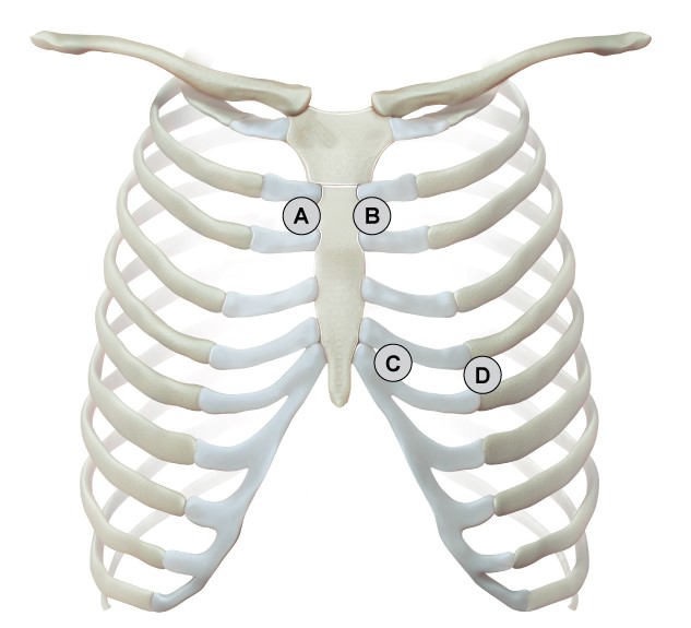 A 33-year-old man comes to the emergency department due to fever, chills, cough, and shortness of breath over the last week.  He smokes a pack of cigarettes a day, consumes 2 or 3 alcoholic beverages daily, and uses intravenous heroin 2 or 3 times per week.  He is febrile and tachycardic.  Blood cultures grow Staphylococcus aureus.  Chest x-ray shows bilateral nodular lesions with areas of cavitation.  The valve most likely affected in this patient can be best evaluated by auscultation at which of the following sites?   A) A B) B C) C D) D