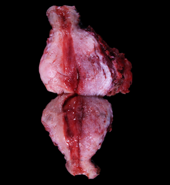 A 45-year-old woman presented to the office due to excessive menstrual bleeding for the past 5 months. The patient has 6 days of heavy bleeding soaking the sanitary pads, which is associated with pain. The menstrual cycle length is around 30-32 days. The patient has no significant past medical or surgical history. The patient was referred for hysterectomy, gross examination of the uterus is shown below.   Which of the following is the most likely diagnosis? A)  Endometriosis B)  Endometritis C)  Uterine Leiomyoma D)  Endometrial Cancer E)  Adenomyosis