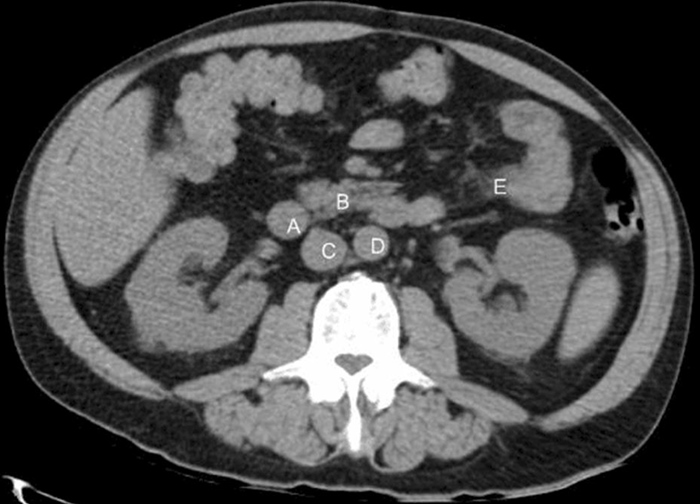 <strong>A 48-year-old man is evaluated for abdominal pain and diarrhea. The patient characterizes his stool as voluminous and foul smelling. He has no significant past medical history. The patient drinks 6 cans of beer daily. On examination, he has normal bowel sounds and mild epigastric tenderness. A 72-hour stool collection shows excessive excretion of fecal fat. A CT scan of the abdomen is shown in the image below. Involvement of which of the following structures is most likely causing this patient's symptoms? </strong> A)A B)B C)C D)D E)E