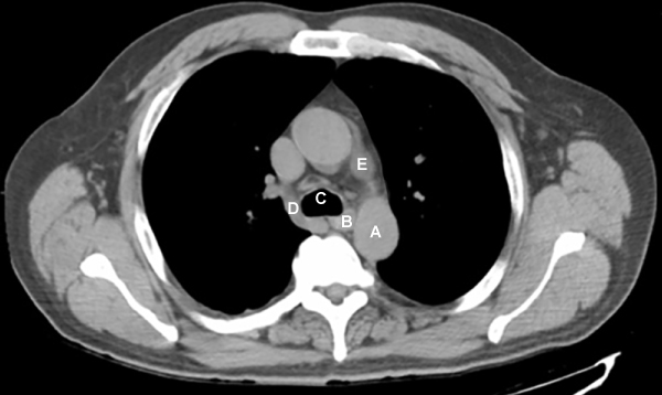 A 35-year-old man presented to the office due to recurrent chest pain. The patient describes pain that the pain extends from the neck down his chest. It has a special onset after fried food. It has no radiation. It does not relate to exercise, not being relieved with rest. The pain awakens him from sleep. Cardiac assessment is normal. A thoracic CT image near the level of the aortic arch is shown below. This patient's presentation is related to which of the following structures?   A) A B) B C) C D) D E) E