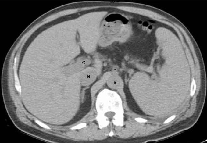 A 53-year-old man who has not seen a physician in years presents to your office complaining of abdominal distention.  He states  Last month my stomach started to swell up and it hasn't gotten any better .  He has no other medical problems.  The patient admits to drinking 10-12 beers a day for the last 20 years.  His temperature is 36.7 C (98 F) , blood pressure is 116/72 mm Hg, pulse is 78/min and respirations are 20/min.  On examination his abdomen is distended with engorged paraumbilical veins.  There is also palmar erythema and multiple spider angiomas are present.  You decided to place him on a low-salt diet and start therapy with furosemide and spironolactone, with subsequent improvement of his abdominal distention.  Before beginning this patient's treatment, which of the following structures labeled on the image below is expected to have an increased pressure?   A) A B) B C) C D) D