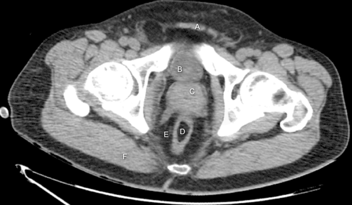 A 53-year-old man presented to the office due to urinary frequency. The patient that he has to wake up several times each night to urinate. He has difficulty with the initiation of urination.  He describes that sometimes he has vague discomfort during voiding. The patient has a medical history of chronic hypertension. He has smoked a pack of cigarettes a day for 30 years.  He was started on finasteride, which of the following organs would be affected by finasteride?   A) A B) B C) C D) D E) E F) F
