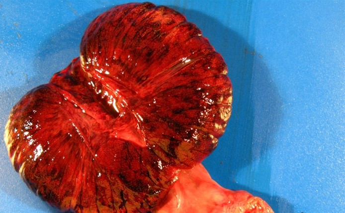 A 16-year-old boy is brought to the emergency department due to severe right groin pain that has worsened over the past 12 hours.  During the last month, the patient has had several episodes of mild scrotal pain while walking between classes at school.  He has no history of traumatic injury and is sexually active.  Medical history is unremarkable except for an inguinal hernia repaired a year ago.  Temperature is 36.9 C (98.4 F) , blood pressure is 116/78 mm Hg, and pulse is 86/min.  On examination, the right hemiscrotum is swollen and tender.  The bisected gross specimen from an orchiectomy is shown in the image below.   Which of the following is the most likely mechanism of this patient's acute testicular pain? A) Abnormal collection of fluid within the scrotum B) Anatomic defect causing increased mobility of the testis C) Clonal proliferation of testicular germ cells D) Migration of bacteria from the urinary tract E) Postsurgical clotting of the pampiniform plexus