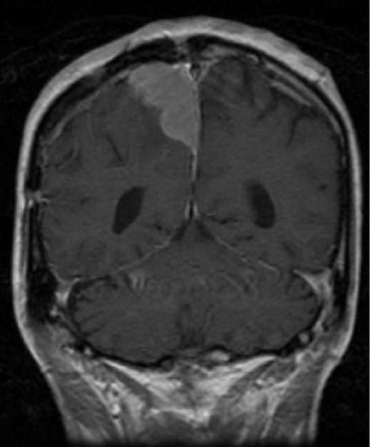 A right-handed 43-year-old woman is assessed in the clinic for increasingly deteriorating neurologic complaints. The patient has diabetes and hyperlipidemia, for which she takes metformin and a statin. There is no history of brain trauma or seizures in her family. The patient consumes wine on occasion but does not use cigarettes or illegal substances. Her mother has a family history of migraines. An MRI of the brain is acquired, as illustrated in the figure below:   This patient is most likely to have which of the following additional findings? A) Bitemporal visual field defects B) Hand weakness and spasticity C) Lower limb sensory loss and hemineglect D) Tinnitus and unilateral hearing loss E) Unilateral ptosis and gaze palsy