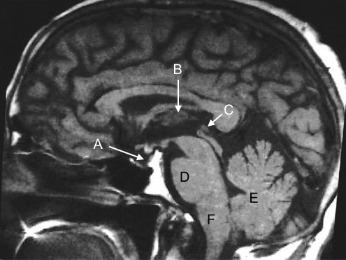 A 4-year-old child is brought to the clinic complaining of headaches that have developed over the last month and are most intense when lying down. He has also been experiencing nonbloody, nonbilious emesis for the past two weeks, which usually happens early in the morning. Furthermore, the youngster experiences periodic fuzzy vision, especially while gazing up at the mirror when brushing his teeth. Bilateral papilledema, difficulty to glance upwards, and bilateral eyelid retraction are all seen on physical examination. Sodium, growth hormone, luteinizing hormone (LH) , and follicle-stimulating hormone (FSH) testing is routine. Given the emesis and papilledema in the early morning, a brain tumor is suspected, and an MRI is requested. Which of the following is the most likely site of the patient's brain lesion? A) A B) B C) C D) D E) E F) F
