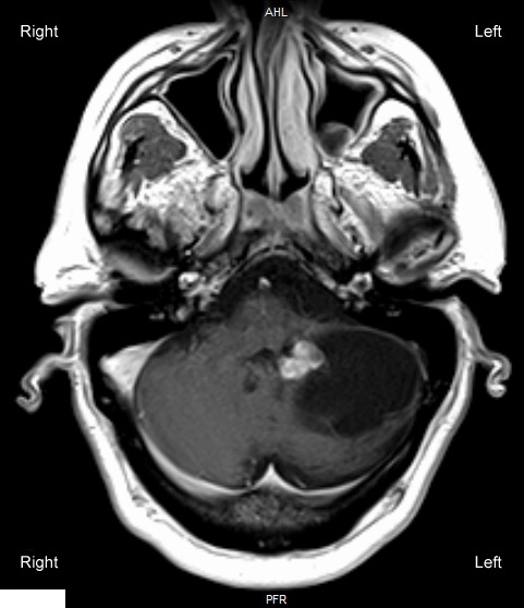 A 55-year-old man arrives at the office complaining of headaches that have worsened during the last two months. The throbbing headaches are commonly accompanied by nausea and increase anytime the patient coughs or bears down during a bowel movement. For episodic migraine without aura, medical history is important. A cystic mass is shown by gadolinium MRI of the brain, as demonstrated in the figure below:   Which of the following findings is most likely to be seen on physical examination of this patient? A) Left dysdiadochokinesia B) Left Horner syndrome C) Left oculomotor nerve palsy D) Photophobia E) Right hemiparesis F) Right hemisensory loss G) Right homonymous hemianopia H) Right lower facial droop