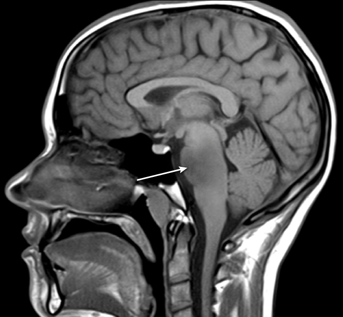 A 12-year-old child is being assessed for severe headaches that have been bothering him for several months. He has also experienced paresthesia, weakness, and extremity rigidity. As illustrated in the figure below, an MRI of the brain reveals an expansile mass in the lower pons:   Which of the following is most likely to be noticed in this patient as a result of the brain lesion's direct involvement of nerve nuclei? A) Asymmetric pupils B) Spontaneous nystagmus C) Tongue atrophy D) Trapezius weakness E) Vertical diplopia