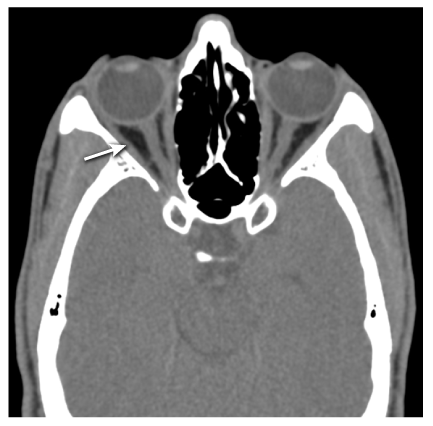 A 32-year-old woman arrives at the clinic complaining of a worsening headache and double vision that has lasted two days. The patient discloses no chronic medical issues but has been experiencing nasal discharge for several days. Physical examination reveals weakness in the muscle seen on the CT scan below:   Purulent discharge from the sphenoethmoidal recess of the nasal cavity is also noted.  Involvement of which of the following nerves best explains this patient's ocular findings? A) Optic nerve B) Oculomotor nerve C) Trochlear nerve D) Ophthalmic division of the trigeminal nerve E) Abducens nerve