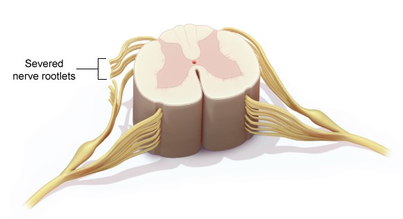 A 6-year-old girl with cerebral palsy has selective dorsal rhizotomy surgery performed. The patient was born early and with a low birth weight, and he suffered periventricular cerebral white matter damage. Dorsal rootlets of lumbosacral spinal nerves are selectively cut during the surgery, as seen in the figure below:   Which of the following is the most likely effect of this intervention in this patient's lower extremities? A) Decreased muscle mass B) Decreased muscle tone C) Increased tendon reflexes D) Muscle fasciculations E) Muscle paralysis