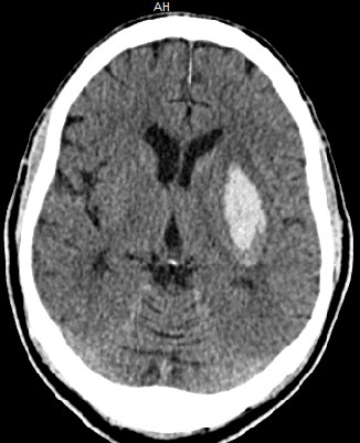 A 65-year-old man is brought to the emergency department due to acute-onset, right-sided weakness and slurred speech.  He also has a severe headache and nausea.  Medical history is significant for poorly controlled hypertension and chronic tobacco use.  Blood pressure is 240/120 mm Hg and pulse is 104/min.  On physical examination, the patient is lethargic with right hemiparesis and lower facial weakness, right hemisensory loss, and dysarthria.  Noncontrast CT scan of the head is shown in the image below.   Which of the following cerebral blood vessels is most likely affected in this patient? A) Cortical branches B) Inferior division of middle cerebral artery C) Lenticulostriate arteries D) Pontine arteries E) Posterior cerebral artery F) Superior division of middle cerebral artery