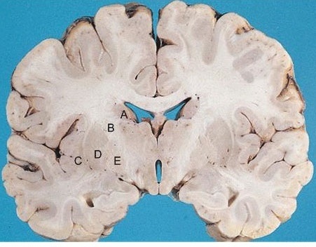 A 38-year-old man is brought to the office for evaluation of behavioral changes.  His wife says the patient has had frequent outbursts of anger, depressive mood, and insomnia.  The patient recently lost his job as a machine operator because of lack of focus and poor memory.  Over the past several years, he also has had involuntary, jerky, nonpurposeful movements of the extremities and face that have progressively worsened.  These abnormal movements are present while he is awake but not during sleep.  His 55-year-old mother has similar abnormal body movements and is at a nursing home with dementia.  Which of the following labeled regions of a normal brain is most likely to be affected by this patient's disease process?   A) A B) B C) C D) D E) E
