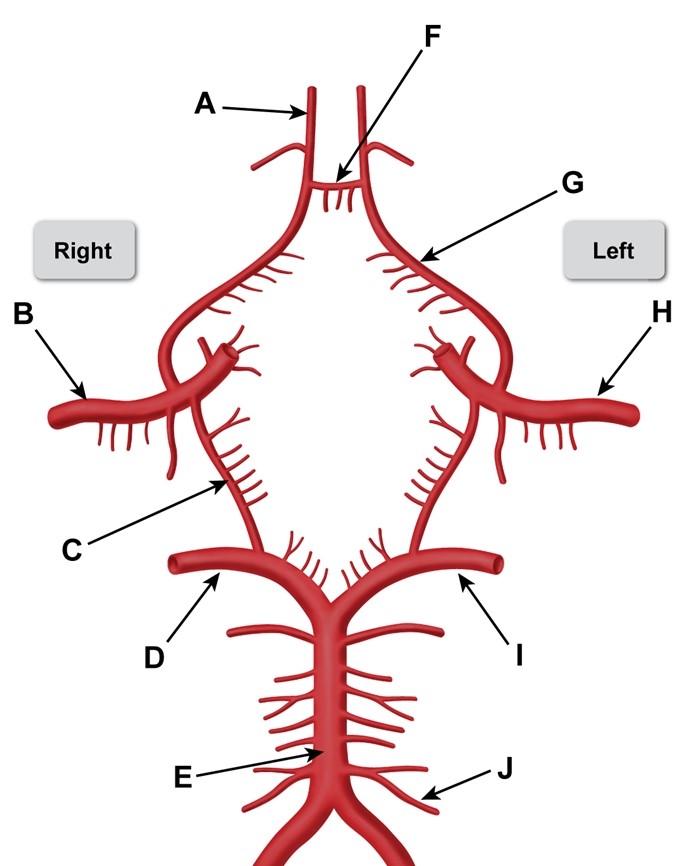 A 66-year-old, right-handed man is brought to the emergency department due to left-sided numbness and weakness.  The patient woke with left-hand clumsiness that rapidly progressed to profound left-sided weakness, affecting the left arm more than the left leg.  He has a history of hypertension and has smoked a pack of cigarettes daily for the past 40 years.  Blood pressure is 175/90 mm Hg and pulse is 82/min and regular.  Neurologic examination reveals impaired touch discrimination in the left arm with left facial weakness sparing the forehead, 2/5 muscle strength in the left upper limb, and 4/5 muscle strength in the left lower limb.  Right-sided strength and visual field examinations are normal.  Which of the following labeled arteries is most likely occluded in this patient?   A) A B) B C) C D) D E) E F) F G) G H) H I) I J) J