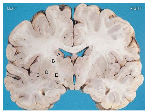 A 62-year-old man arrives to the office with clumsiness in his right arm. A physical examination indicates right arm and leg motor weakness. The patient's speech is slurred, and his right lower face is sagging. When the right arm is passively flexed, there is early resistance followed by a dramatic release of tension as the flexion continues. Which of the following brain structures is most likely to blame for this patient's condition?   A) A B) B C) C D) D E) E