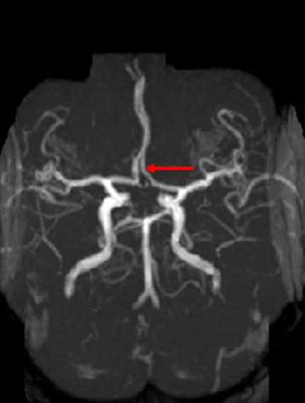 A 68-year-old man is evaluated for visual loss in the left eye that resolved spontaneously within several hours.  The patient has a history of hypertension, type 2 diabetes mellitus, coronary artery disease, and ischemic cardiomyopathy.  He has smoked a pack of cigarettes daily for the past 40 years.  Physical examination reveals a left carotid bruit but no neurologic deficits.  A carotid duplex ultrasound shows 85% stenosis of the left internal carotid artery, and carotid angiography with stenting is performed.  During the procedure, atherosclerotic debris embolize to the artery shown (red arrow)  on the cerebral magnetic resonance angiograph below.   Which of the following actions is most likely to be impaired in this patient? A) Climbing stairs B) Gripping C) Speaking D) Swallowing food E) Whistling