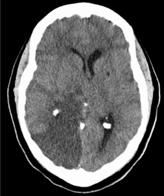 A 70-year-old right-handed woman arrives at the ER with left-sided sight loss that she noticed when she awoke in the morning. She has no headaches, impaired speech, swallowing difficulties, weakness, or trouble walking. Her additional medical issues include high blood pressure, atrial fibrillation, and hyperlipidemia. The blood pressure is 170/102 mm Hg, and the pulse rate is 90 beats per minute and irregular. She is aware and oriented to person, location, and time during a neurologic assessment. Her voice is clear, and she understands and executes complex orders. Her visual fields reveal left homonymous hemianopia with macular sparing. Her feeling on the left side of her body is diminished. The rest of the neurologic evaluation is within normal norms. As depicted in the picture, a non-contrast head CT shows an area of focal parenchymal hypoattenuation.   Which of the following cerebral arteries is most likely to be compromised in this patient? A) Anterior cerebral artery B) Anterior choroidal artery C) Artery of Percheron D) Basilar artery E) Middle cerebral artery F) Posterior cerebral artery