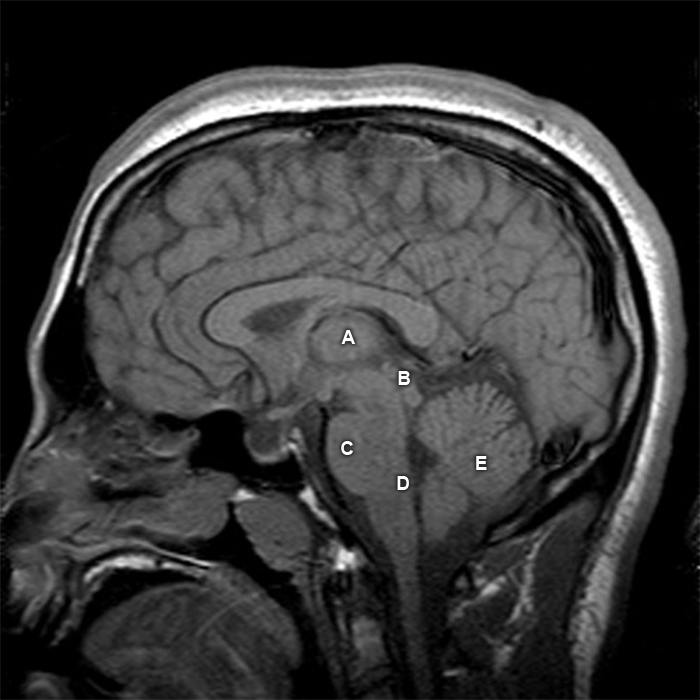 A 34-year-old man begins treatment for Hodgkin lymphoma with combined chemotherapy. Shortly later, he begins vomiting violently and requires IV fluid replacement. Which of the following brain regions is most likely to be to blame for his symptoms?   A) A B) B C) C D) D E) E