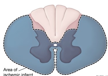 A 58-year-old man had a descending thoracic aortic aneurysm repaired surgically. There are no intraoperative problems, but the patient develops new-onset neurologic impairments after surgery. The brain imaging is normal, but an MRI of the lower thoracic spinal cord indicates an ischemic infarction in the locations depicted in the example below.   Lower extremity examination of this patient is most likely to show which of the following neurologic findings?   A) A B) B C) C D) D E) E F) F