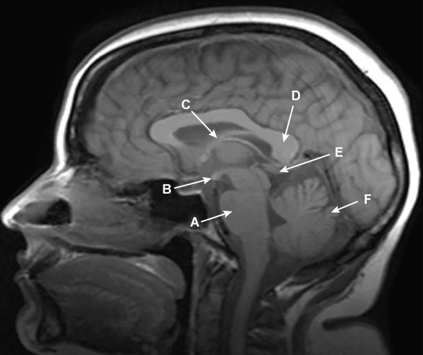Due to memory loss and frequent falls, a 62-year-old man is brought to the office by his son. The patient has been living alone since his wife died a year ago. His visiting son discovered his father in deplorable living circumstances. The patient was forgetful and didn't recall where certain belongings in his residence, where he had resided for almost 20 years, were located. His walk is extremely shaky, and he has fallen multiple times. According to his son, his father has always been  a drinker  and may have been drinking recently. The patient appears unconcerned about his son's fears and claims to be OK. The vital indicators are within normal ranges. On physical examination, bilateral lateral gaze palsy and nystagmus are present.  Muscle strength and deep tendon reflexes are normal, but the gait is ataxic.  On memory testing, he recalls 0 out of 3 objects after 5 minutes.  A lesion of which of the following labeled structures on a normal brain MRI is most specifically associated with this patient's current condition?   A) A B) B C) C D) D E) E F) F