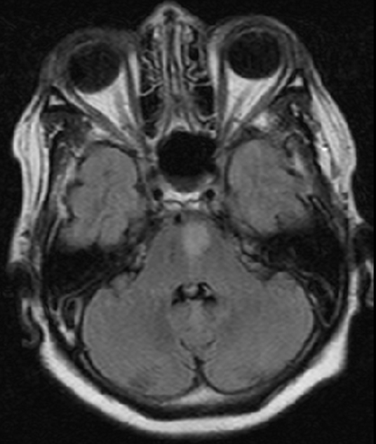 A 65-year-old man comes to the emergency department due to acute-onset slurred speech.  He also has right-sided weakness but denies any trauma, headache, or loss of consciousness.  His medical problems include hypertension and type 2 diabetes mellitus.  The patient has smoked 1 pack of cigarettes daily for 20 years.  Neurologic examination shows right-sided lower facial droop with sparing of the forehead muscles.  Motor strength is 3/5 on the right and 5/5 on the left with a Babinski response on the right.  There is also dysmetria and dysdiadochokinesia involving his right upper and lower extremities.  MRI of the brain reveals an acute lacunar infarct in the brainstem, as shown in the image below.   Which of the following cranial nerves exits the brainstem closest to the level affected by this patient's stroke? A) Facial B) Hypoglossal C) Oculomotor D) Trigeminal E) Trochlear