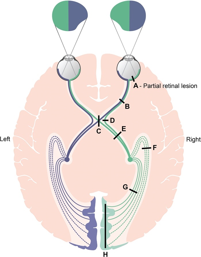A 67-year-old woman visits the clinic because she has observed diminished vision in her right eye for the last week. The patient claims that her right eye's vision is  narrower  than her left. Her medical history is notable for hypertension, type 2 diabetes, and hyperlipidemia. She also has intermittent lower limb claudication and has experienced two previous instances of transitory vision loss in her right eye. A right nasal hemianopia is shown by visual field testing. A right internal carotid artery aneurysm is discovered during a head and neck MRI/magnetic resonance angiography. Which of the following visual pathway segments is most likely disturbed in this patient?  A) A B) B C) C D) D E) E F) F G) G H) H