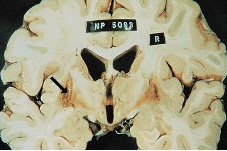 A 54-year-old Caucasian male dies from a progressive neurological disorder.  A brain section of the patient is shown below.   Which of the following corresponds to the structure with cystic degeneration (black arrow) ? A) Globus pallidus B) Putamen C) Internal capsule D) Caudate nucleus E) Amygdala