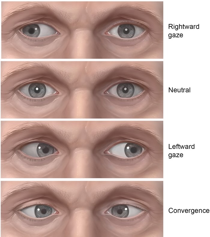 A 68-year-old woman arrives at the emergency room with rapid onset double vision that began shortly after she awoke. When she looks to the right, the patient's vision deteriorates. She does not have a headache, weakness, or numbness. The patient has a lengthy history of high blood pressure, hyperlipidemia, and type 2 diabetes. The blood pressure is 160/90 mm Hg, and the pulse rate is 86 beats per minute. Except for the ocular abnormalities depicted in the figure below, the neurologic evaluation, including visual acuity, is normal.   A lesion involving which of the following structures is most likely causing the observed ocular findings in this patient? A) Abducens nerve B) Lateral geniculate nucleus C) Medial longitudinal fasciculus D) Occipital lobe E) Oculomotor nerve F) Superior colliculus