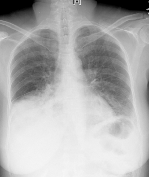 A previously healthy 35-year-old lady arrives at the hospital after several days of productive coughing accompanied by chills and fever. Her sputum is purulent, with slight pink blood streaks. Deep inspiration has also caused acute discomfort throughout the right shoulder and neck area. The patient's medical history is ordinary. Her temperature is 38.3 degrees Celsius (101 degrees Fahrenheit) , her blood pressure is 130/70 mm Hg, her pulse is 98 bpm, and her respirations are 22 /minute. The right lower pulmonary lobe exhibits crackles and dullness on examination. The examiner has the patient speak the letter  E  while listening with the stethoscope over the right midback, and the sound is heard by the examiner as a loud letter  A.  A chest x-ray is obtained and is shown in the image below.   The pain experienced by this patient is most likely carried by which of the following nerves? A) Accessory B) Intercostal C) Long thoracic D) Phrenic E) Vagus