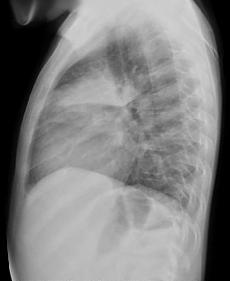 A 13-year-old girl has been taken to the hospital with a fever, cough, and malaise for the previous two days. She has no history of illness, and all of her vaccines are current. Her leukocyte count is 21,000/mm<sup>3</sup>, and she has 7% band formations. The following are the results of an upright chest x-ray:   Which of the following is the most likely location of the pathologic process in this patient? A) Left lower lung lobe B) Left pleural space C) Right middle lung lobe D) Right pleural space E) Right upper lung lobe