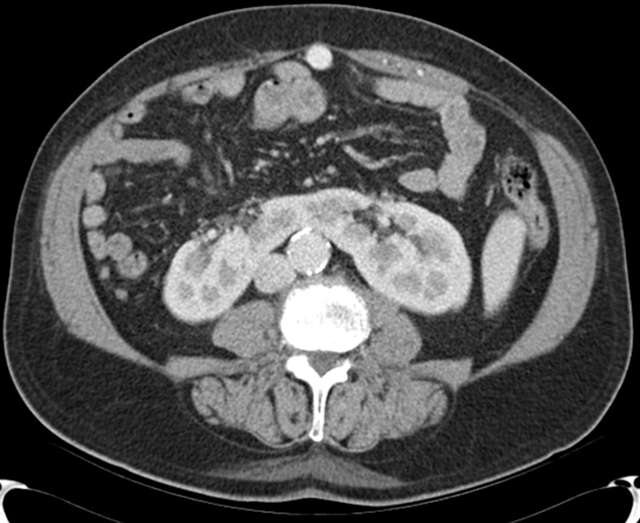 <strong>A 47-year-old lady arrives at the clinic with a fever, dysuria, and abdominal discomfort. She has experienced multiple urinary tract infections throughout her adolescence, but no other medical issues. A physical examination indicates that the patient is experiencing minor suprapubic pain. Urinalysis reveals pyuria as well as many microorganisms. A CT scan of the abdomen is performed, as seen in the figure below.   Which of the following most likely prevented the proper ascent of the anomalous organ seen on the CT scan?</strong> A)Inferior mesenteric artery B)Inferior vena cava C)Persistent urachus D)Superior mesenteric artery E)Vitellointestinal duct <div style=padding-top: 35px> 