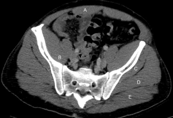 <strong>A 32-year-old man arrives in the ER complaining of acute heart palpitations. His blood pressure is 100/70 mmHg, and his heart rate is 160 beats per minute. To alleviate these symptoms, the doctor tells the patient to do the Valsalva technique. Which of the following structures is most crucial in completing the Valsalva technique, as seen in the pelvic CT scan below?  </strong> A)A B)B C)C D)D E)E <div style=padding-top: 35px> 