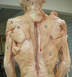 A 21-year-old man is brought to the emergency department following an assault.  He was attempting to escape and turned away just as his attacker lunged toward him from behind with a knife.  The patient suffered a 4-cm-wide penetrating injury with significant associated blood loss.  Following initial stabilization, he is transferred to the operating room.  Surgical exploration reveals injury to a muscle that assists in internal rotation of the arm and is innervated by the thoracodorsal nerve.  Which of the following muscles depicted in the cadaveric specimen is most likely injured in this patient?   A) A B) B C) C D) D E) E