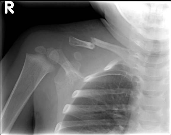 A 3-year-old boy is brought to the emergency department after falling off a jungle gym.  The boy tried to catch himself and landed on his outstretched arms.  He did not lose consciousness and has been crying inconsolably since he fell.  Pulse is 140/min; all other vital signs are within normal limits.  Physical examination reveals tenderness and swelling over the anterior portion of his right shoulder with crepitus over the swollen area.  An x-ray of his right shoulder is shown below.   Tension from which of the following muscles is most likely responsible for displacement of the distal bone fragment? A) Biceps B) Deltoid C) Levator scapulae D) Pectoralis minor E) Teres minor